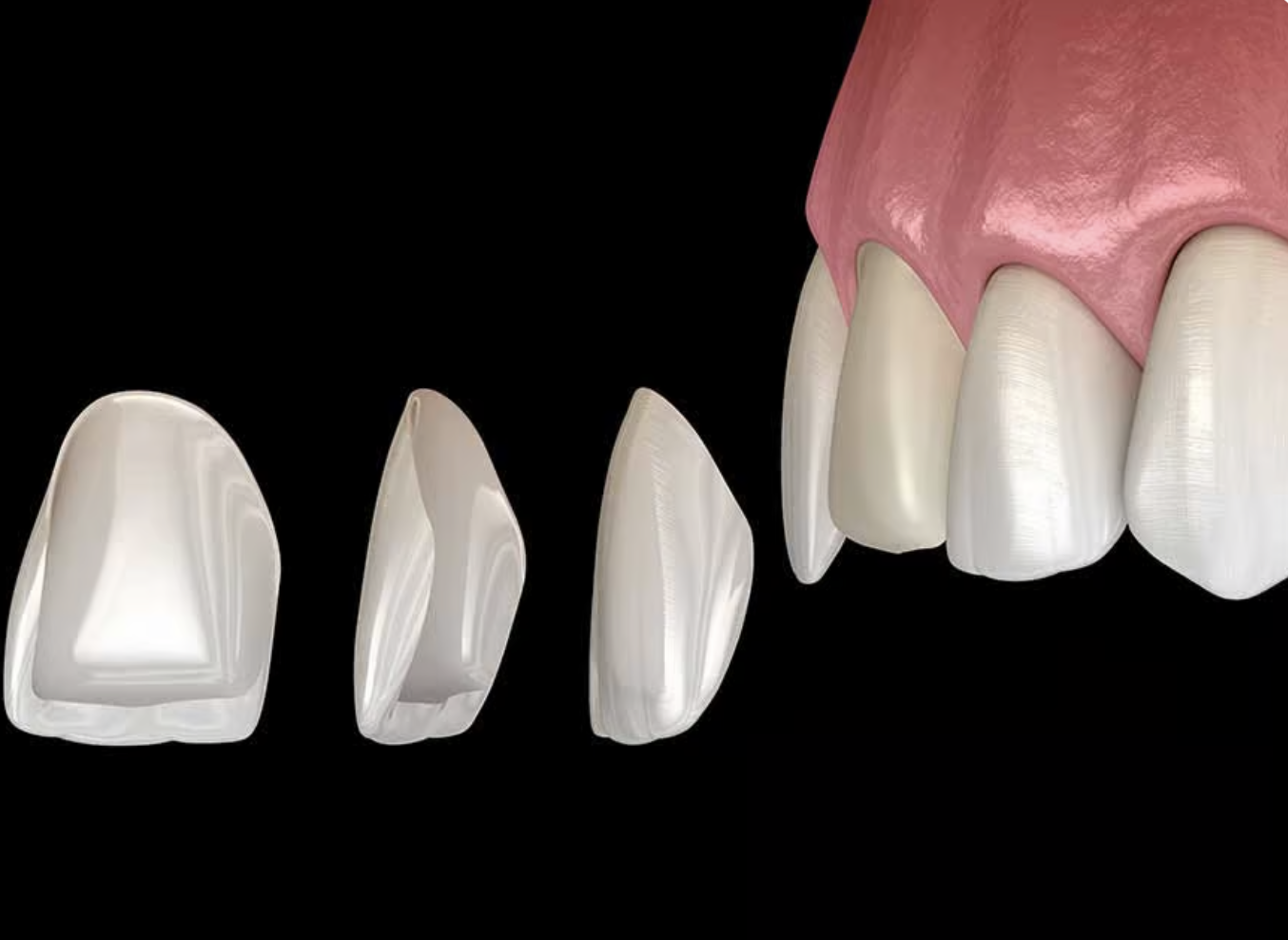 e.max Lithium Disilicate Veneers