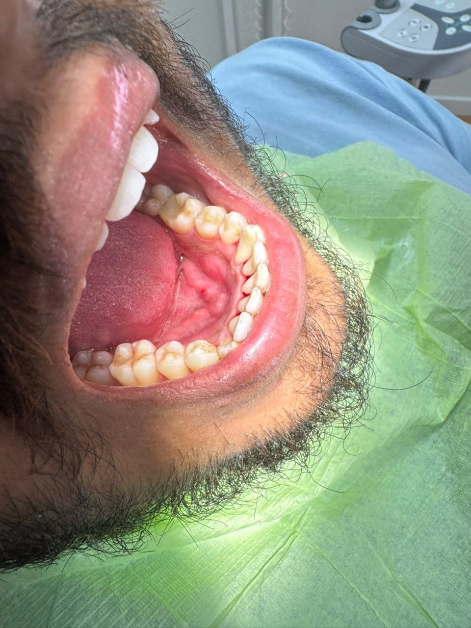 After veneers