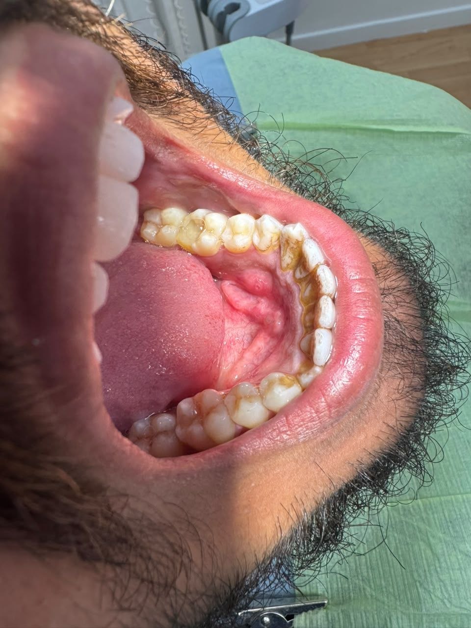 Before veneers