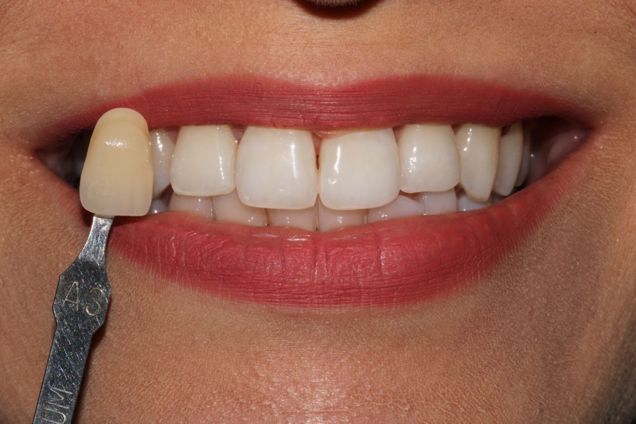 After whitening