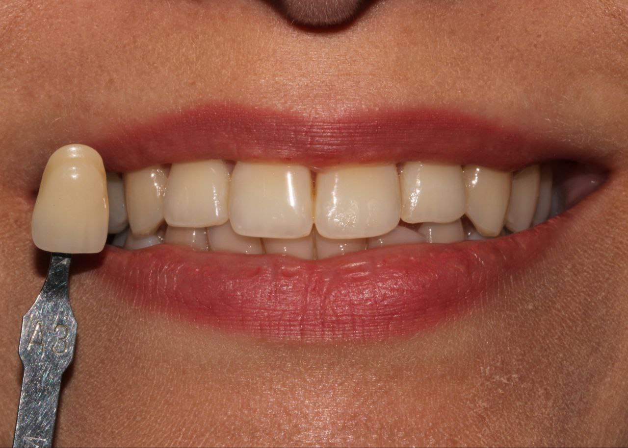 Before whitening